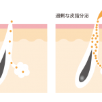 過剰な皮脂分泌はニキビの原因のひとつ