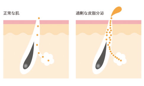 過剰な皮脂分泌はニキビの原因のひとつ
