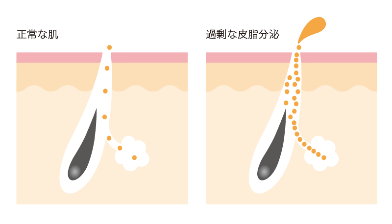 過剰な皮脂分泌はニキビの原因のひとつ